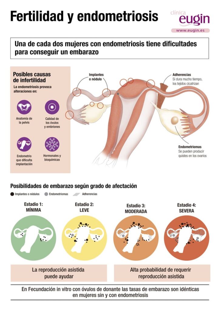 como impacta la endometriosis en la fertilidad