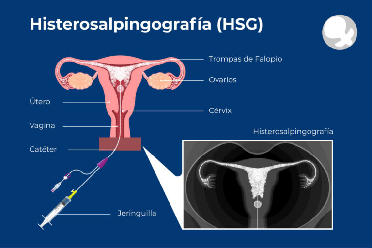 Qué Es Una Biopsia Endometrial Y Cuándo Se Necesita | Salud Vital ...