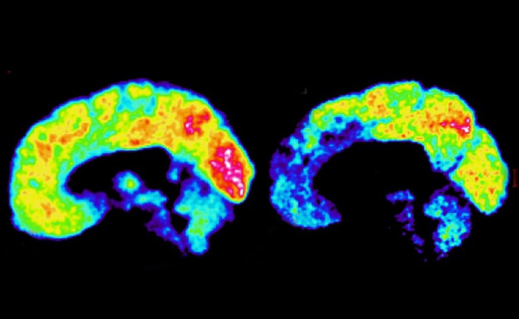 Cerebro de psicópatas: hallazgos y análisis recientes 1 cerebro de psicopatas hallazgos y analisis recientes