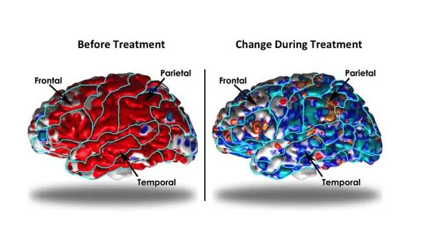 Qué alteraciones cerebrales se observan en la depresión 1 que alteraciones cerebrales se observan en la depresion