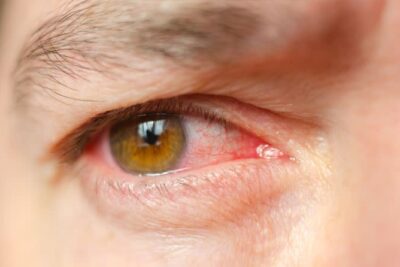 sintomas de infeccion ocular en hadas guia de identificacion
