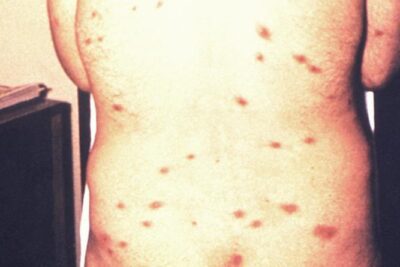 sintomas del vih reconocerlos para un diagnostico temprano