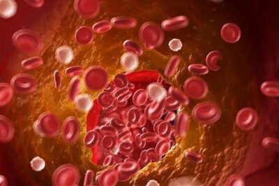 trombos la causa oculta de millones de muertes anuales