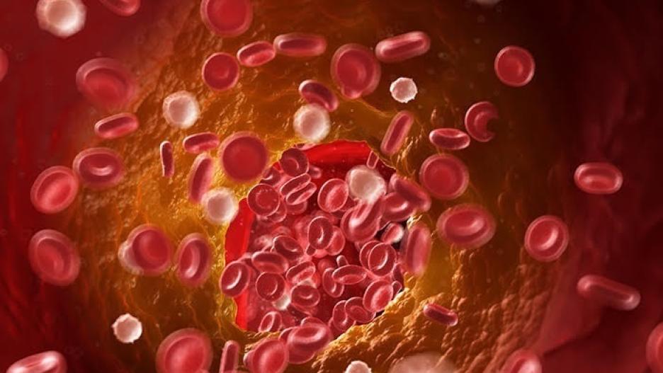 trombos la causa oculta de millones de muertes anuales