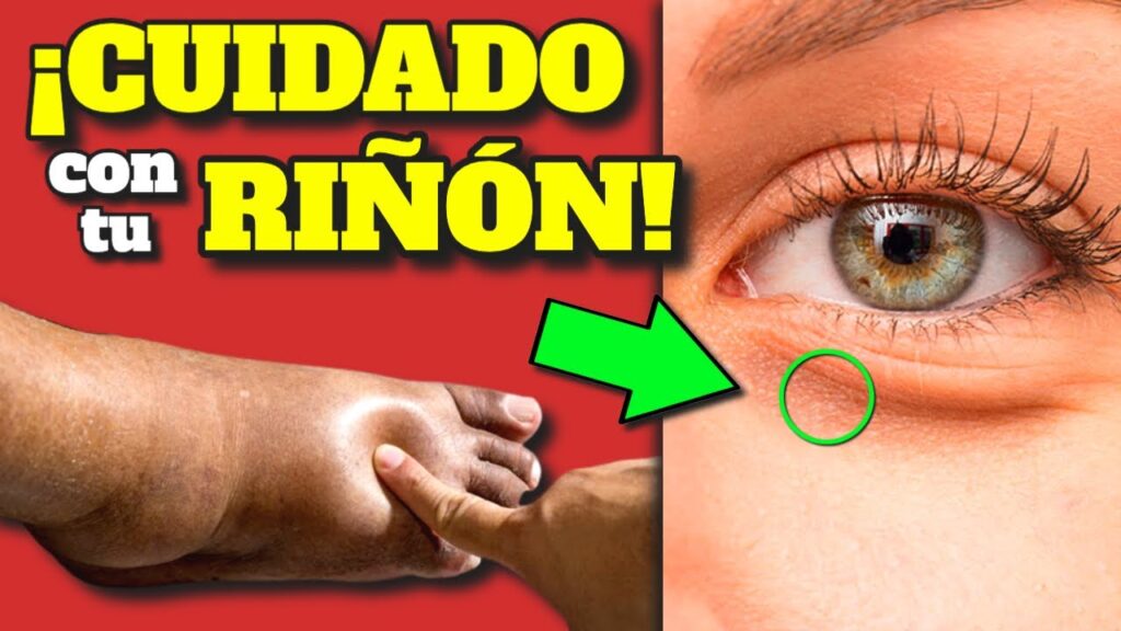 alerta renal sintomas clave de fallo renal y prevencion