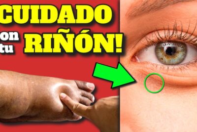 alerta renal sintomas clave de fallo renal y prevencion