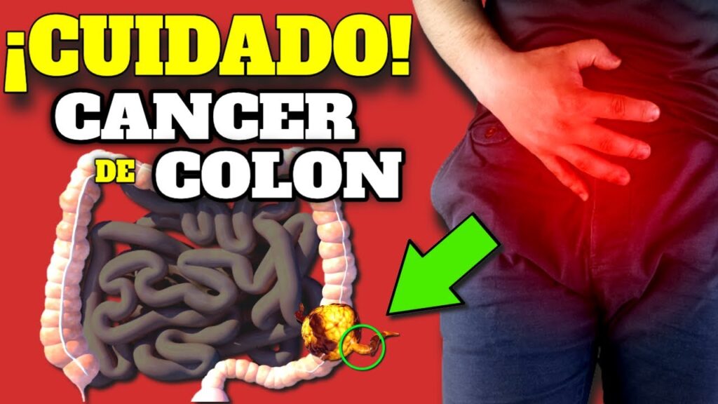 cancer de colon sintomas tempranos y prevencion