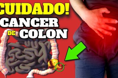 cancer de colon sintomas tempranos y prevencion