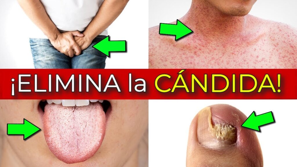 candidiasis elimina el hongo y recupera tu salud