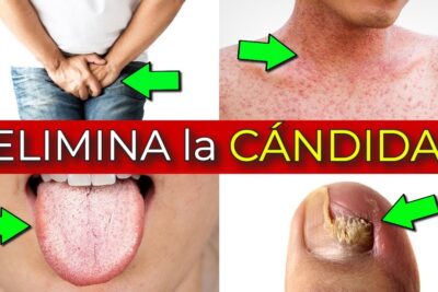 candidiasis elimina el hongo y recupera tu salud