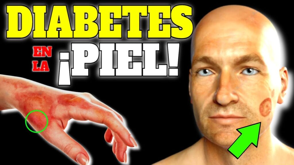diabetes en la piel 5 sintomas tempranos que debes conocer