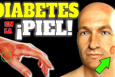 diabetes en la piel 5 sintomas tempranos que debes conocer