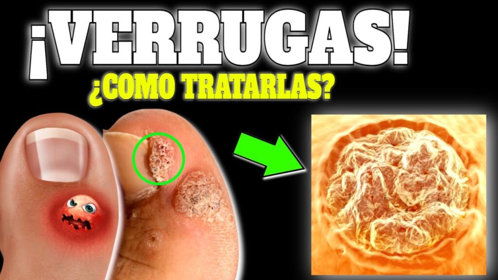 elimina verrugas en la piel guia completa y efectiva