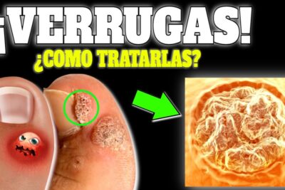 elimina verrugas en la piel guia completa y efectiva