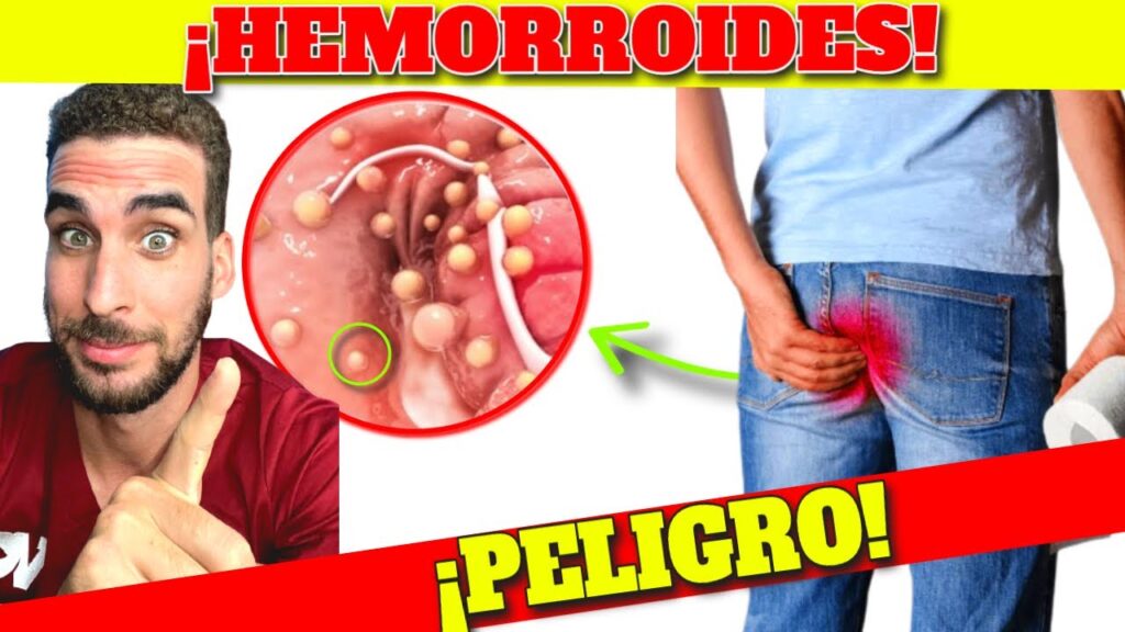 hemorroides sintomas alarma y cura natural