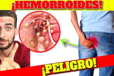 hemorroides sintomas alarma y cura natural