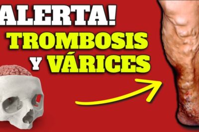 mejora la circulacion adios varices y mala circulacion