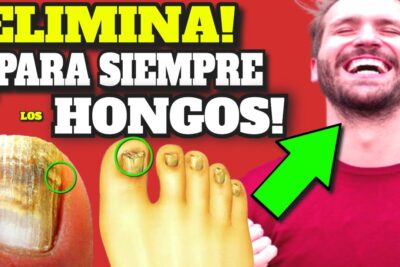 onicomicosis tratamiento eficaz para el hongo en unas