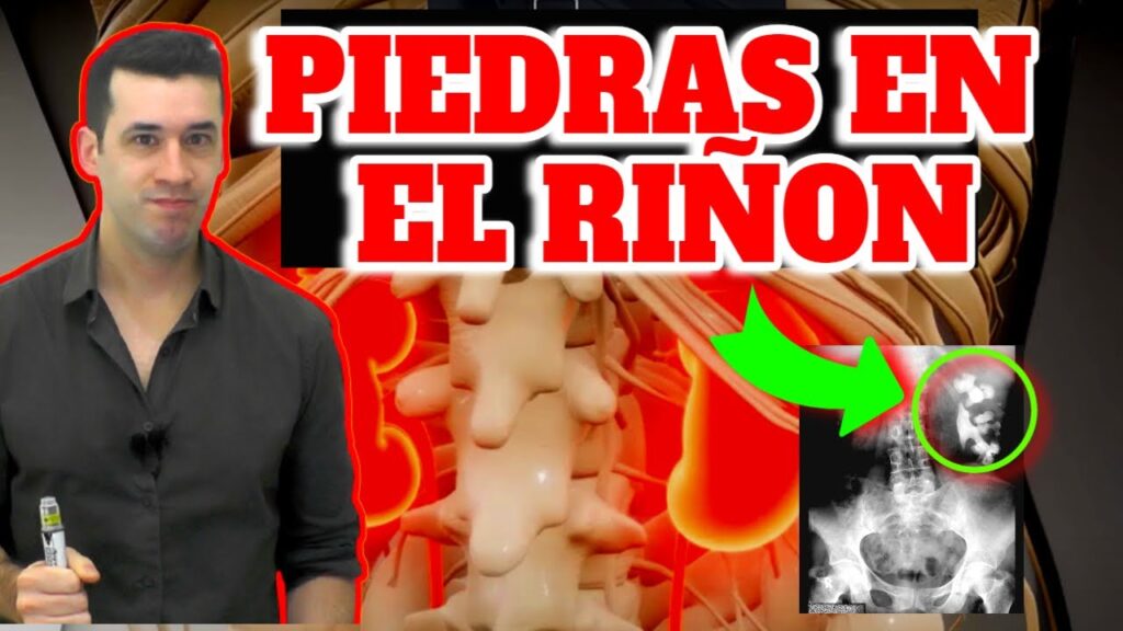 Piedras en el Riñón: Una Guía Completa para la Salud Renal 1 piedras en el rinon una guia completa para la salud renal