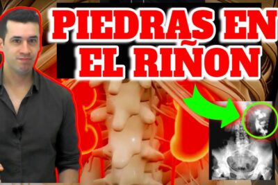 piedras en el rinon una guia completa para la salud renal