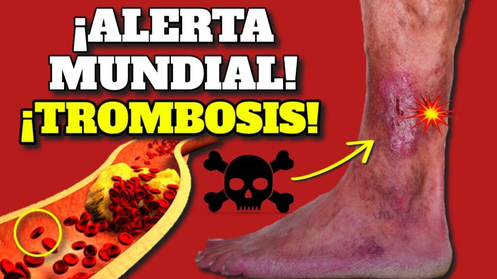 trombosis sintomas prevencion y tratamiento guia completa