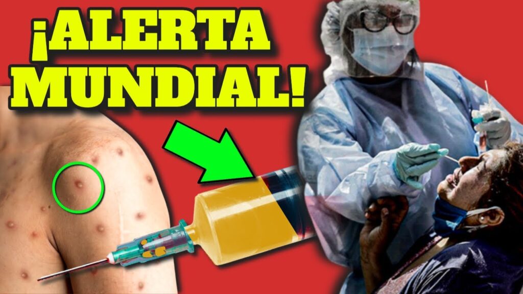 viruela del mono alerta mundial y guia completa de prevencion