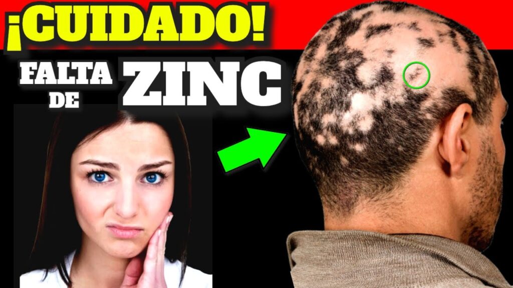 zinc senales de deficiencia y alimentos para combatirla