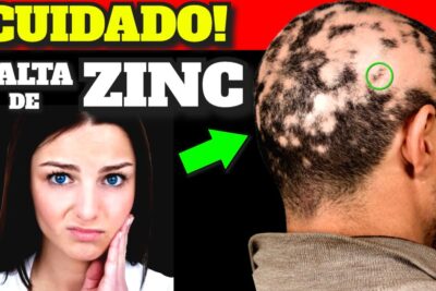 zinc senales de deficiencia y alimentos para combatirla